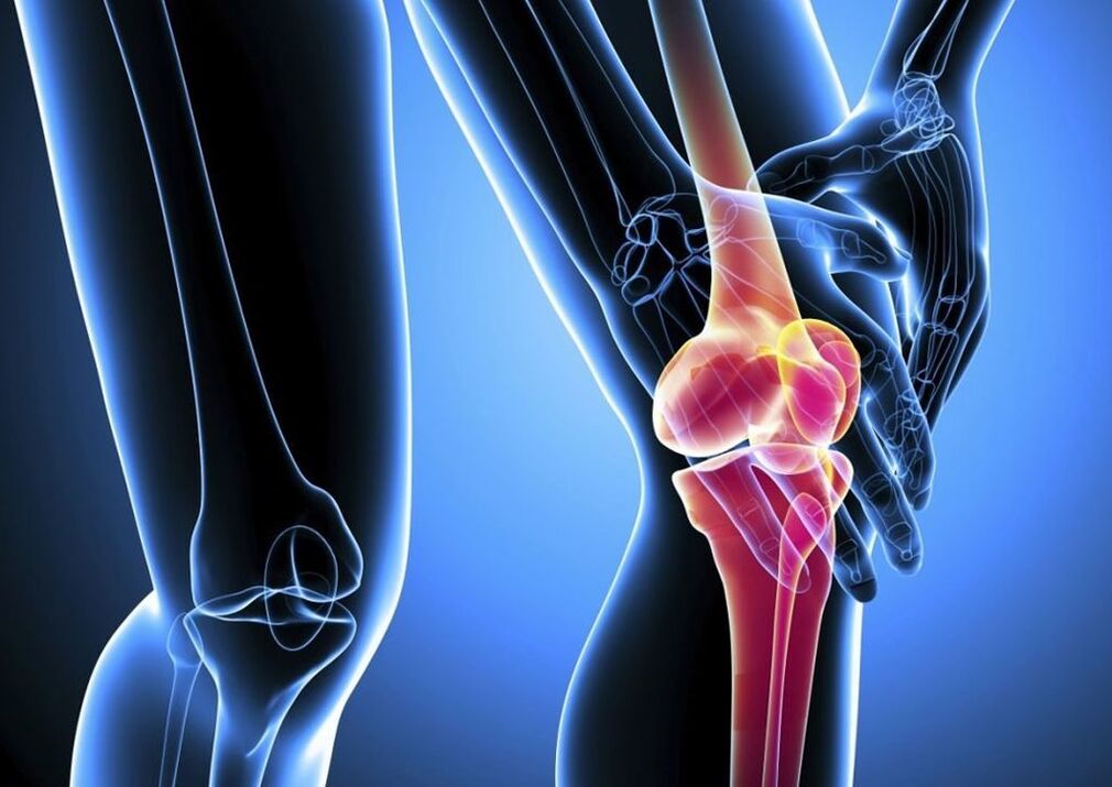 Schmerzen bei körperlicher Aktivität bei Arthrose des Kniegelenks
