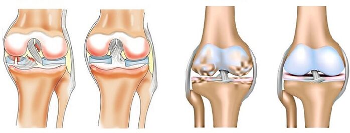 Unterschied zwischen Arthritis (links) und Arthrose (rechts) der Gelenke