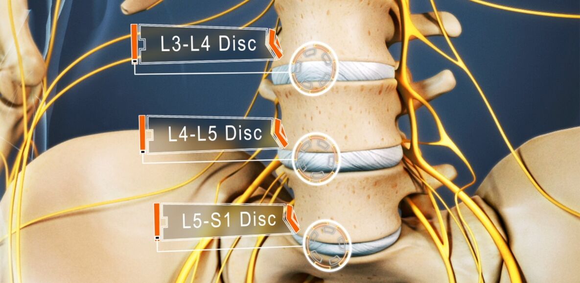Bandscheiben der Lendenwirbelsäule, die bei Osteochondrose am häufigsten betroffen sind
