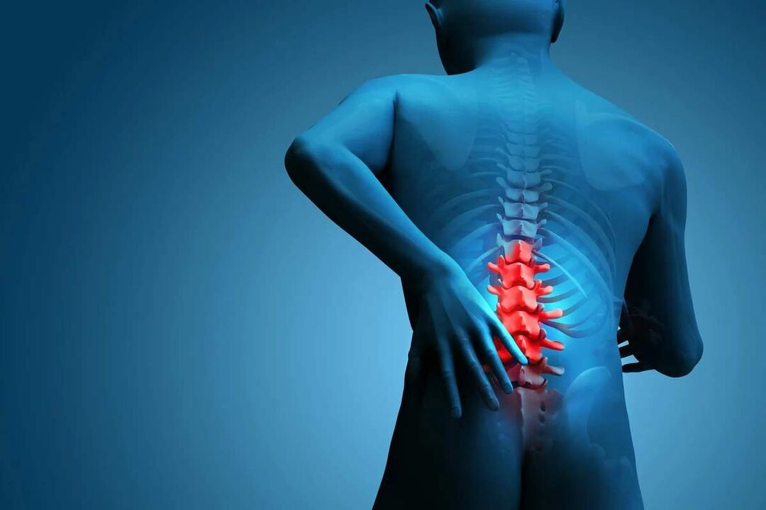 Das Hauptsymptom der Osteochondrose der Lendenwirbelsäule sind Rückenschmerzen. 