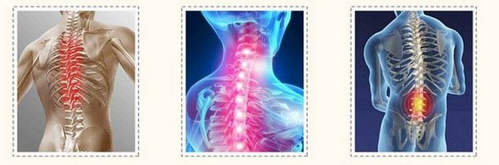 Osteochondrose unterschiedlicher Wirbelsäule