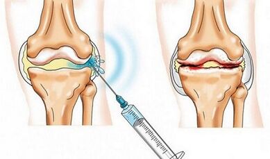 Die Blockade des Kniegelenks für Arthrose