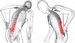 Zwischenwirbelhernie - Komplikation mit Osteochondrose