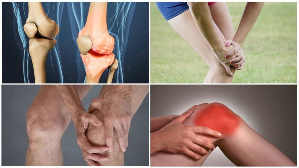 Arthrosestadien