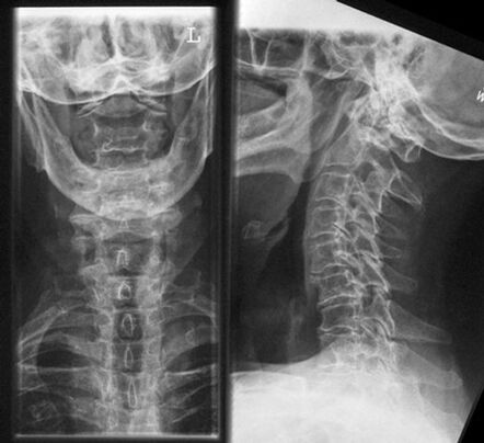 Cervical X -Ray - Diagnose der Osteochondrose -Methode