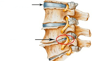 Normale und beschädigte Wirbelsäule mit zervikaler Osteochondrose