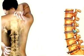 Rückenschmerzen in verschiedenen Stadien der Entwicklung der zervikalen Osteochondrose