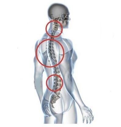 Stellen der spinalen Osteochondrose